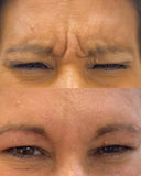 Botox/Dysport/Xeomin/Jeuveau