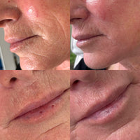 RF Microneedling