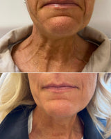 Botox/Dysport/Xeomin/Jeuveau