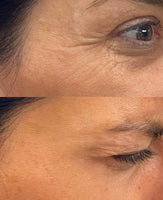 Botox/Dysport/Xeomin/Jeuveau