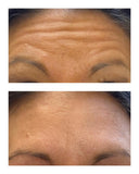 Botox/Dysport/Xeomin/Jeuveau