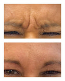 Botox/Dysport/Xeomin/Jeuveau