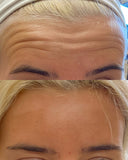 Botox/Dysport/Xeomin/Jeuveau