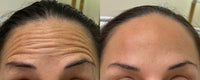 Botox/Dysport/Xeomin/Jeuveau