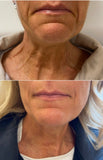 Botox/Dysport/Xeomin/Jeuveau