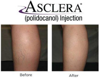 Asclera Spider Vein Removal