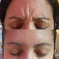 Botox/Dysport/Xeomin/Jeuveau