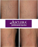 Asclera Spider Vein Removal